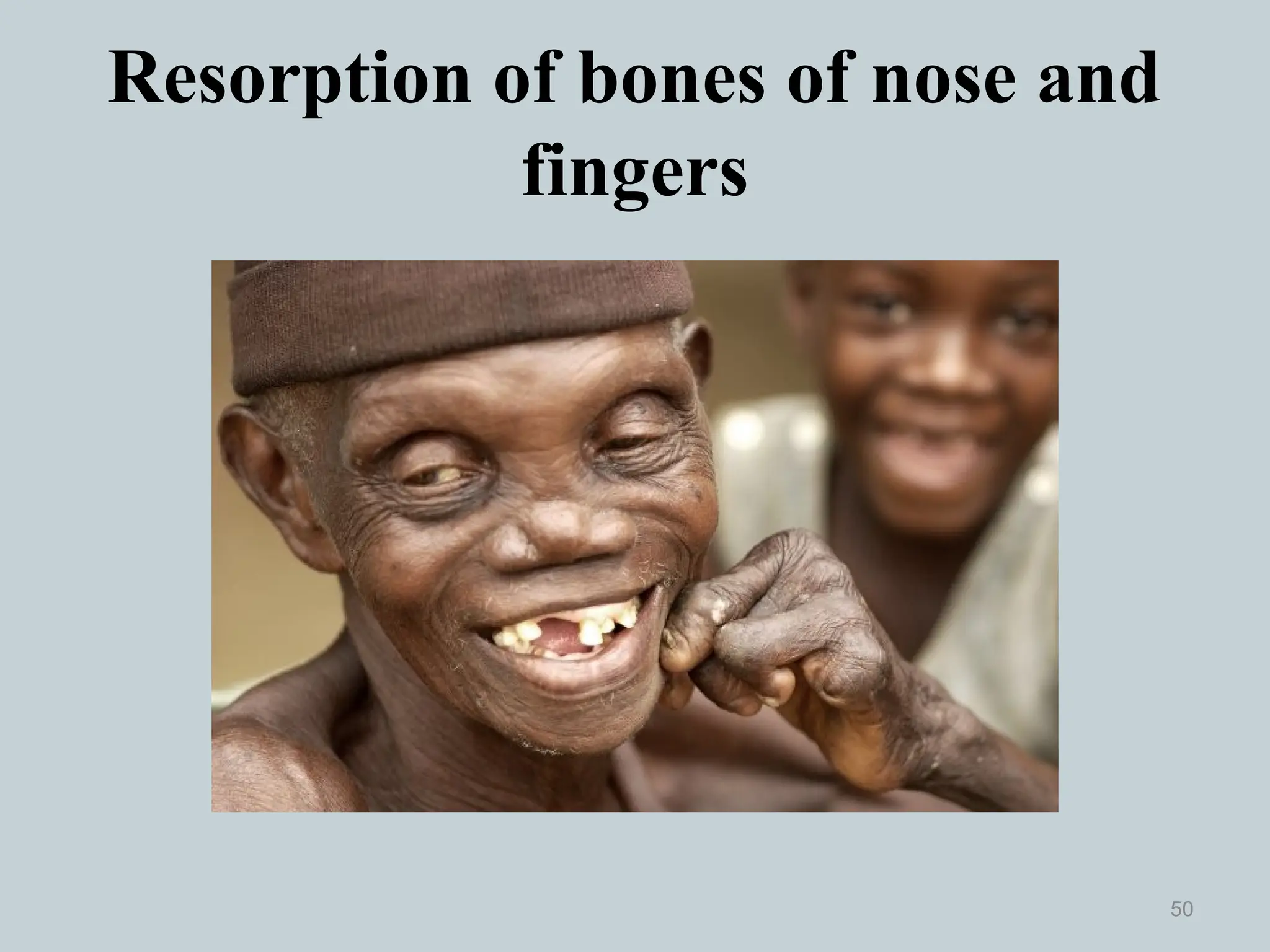 Resorption of bones of nose and
fingers
50
 