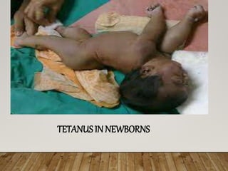 TETANUS IN NEWBORNS
 