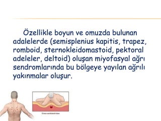 Özellikle boyun ve omuzda bulunan
adalelerde (semisplenius kapitis, trapez,
romboid, sternokleidomastoid, pektoral
adeleler, deltoid) oluşan miyofasyal ağrı
sendromlarında bu bölgeye yayılan ağrılı
yakınmalar oluşur.
 