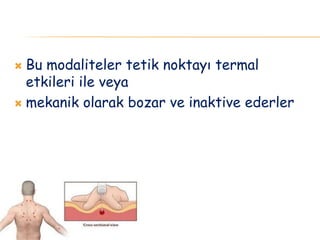  Bu modaliteler tetik noktayı termal
etkileri ile veya
 mekanik olarak bozar ve inaktive ederler
 