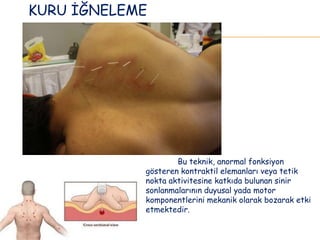 Bu teknik, anormal fonksiyon
gösteren kontraktil elemanları veya tetik
nokta aktivitesine katkıda bulunan sinir
sonlanmalarının duyusal yada motor
komponentlerini mekanik olarak bozarak etki
etmektedir.
KURU İĞNELEME
 