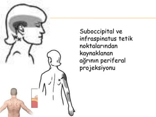 Suboccipital ve
infraspinatus tetik
noktalarından
kaynaklanan
ağrının periferal
projeksiyonu
 