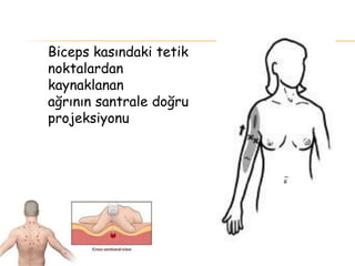 Biceps kasındaki tetik
noktalardan
kaynaklanan
ağrının santrale doğru
projeksiyonu
 