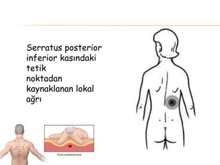 Serratus posterior
inferior kasındaki
tetik
noktadan
kaynaklanan lokal
ağrı
 