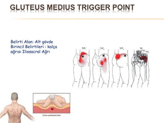 GLUTEUS MEDIUS TRIGGER POINT
Belirti Alan: Alt gövde
Birincil Belirtileri : kalça
ağrısı Iliosacral Ağrı
 