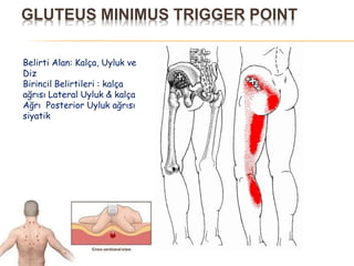 GLUTEUS MINIMUS TRIGGER POINT
Belirti Alan: Kalça, Uyluk ve
Diz
Birincil Belirtileri : kalça
ağrısı Lateral Uyluk & kalça
Ağrı Posterior Uyluk ağrısı
siyatik
 