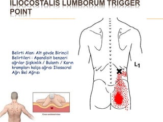 ILIOCOSTALIS LUMBORUM TRIGGER
POINT
Belirti Alan: Alt gövde Birincil
Belirtileri : Apandisit benzeri
ağrılar Şişkinlik / Bulantı / Karın
krampları kalça ağrısı Iliosacral
Ağrı Bel Ağrısı
 