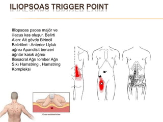 ILIOPSOAS TRIGGER POINT
Illiopsoas psoas majör ve
iliacus kas oluşur. Belirti
Alan: Alt gövde Birincil
Belirtileri : Anterior Uyluk
ağrısı Apandisit benzeri
ağrılar kasık ağrısı
Iliosacral Ağrı lomber Ağrı
Sıkı Hamstring , Hamstring
Kompleksi
 