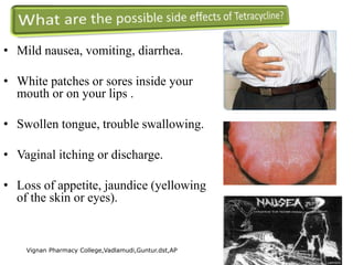 • Mild nausea, vomiting, diarrhea.
• White patches or sores inside your
mouth or on your lips .
• Swollen tongue, trouble swallowing.
• Vaginal itching or discharge.
• Loss of appetite, jaundice (yellowing
of the skin or eyes).
Vignan Pharmacy College,Vadlamudi,Guntur.dst,AP 32
 