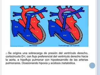 o Se origina una sobrecarga de presión del ventrículo derecho,
cortocircuito D-I, con flujo preferencial del ventrículo derecho hacia
la aorta, e hipoflujo pulmonar con hipodesarrollo de las arterias
pulmonares. Ocasionando hipoxia y acidosis metabólica.

 