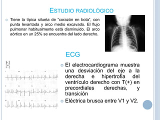 ESTUDIO RADIOLÓGICO


Tiene la típica silueta de “corazón en bota”, con
punta levantada y arco medio excavado. El flujo
pulmonar habitualmente está disminuido. El arco
aórtico en un 25% se encuentra del lado derecho.

ECG
El electrocardiograma muestra
una desviación del eje a la
derecha e hipertrofia del
ventrículo derecho con T(+) en
precordiales
derechas,
y
transición
 Eléctrica brusca entre V1 y V2.


 