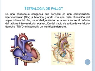 TETRALOGIA DE FALLOT
Es una cardiopatía congénita que consiste en una comunicación
interventricular (CIV) subaórtica grande con una mala alineación del
septo interventricular, un acabalgamiento de la aorta sobre el defecto
del tabique interventricular obstrucción del tracto de salida de ventrículo
derecho (TSVD) e hipertrofia del ventrículo derecho.

 