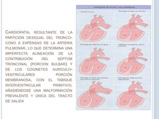 CARDIOPATIA,

RESULTANTE DE LA

PARTICIÓN DESIGUAL DEL TRONCOCONO A EXPENSAS DE LA ARTERIA
PULMONAR, LO QUE DETERMINA UNA

IMPERFECTA

ALINEACIÓN

CONTRIBUCIÓN
LOS

LA

DEL

SEPTÙM

(PORCION

BULBAR) Y

COGINETES

AURICULO-

TRONCONAL
DE

DE

VENTRICULARES

MEMBRANOSA,

PORCIÓN

CON

INTERVENTRICULAR

EL

TABIQUE
PRIMITIVO;

AÑADIÉNDOSE UNA MALFORMACIÓN
PREVALENTE Y ÚNICA DEL TRACTO
DE SALIDA

 