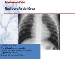 Tetralogía de Fallot


    Radiografía de tórax




Cardiomegalia leve
Arco de la pulmonar excavado
Levantamiento de la punta del corazón
Oligohemia pulmonar
Arco aortico derecho (25%)
 