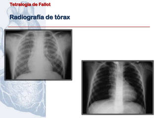 Tetralogía de Fallot


Radiografía de tórax
 