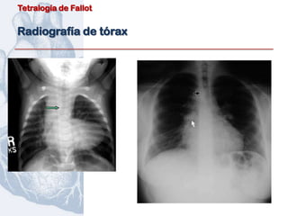 Tetralogía de Fallot


Radiografía de tórax
 