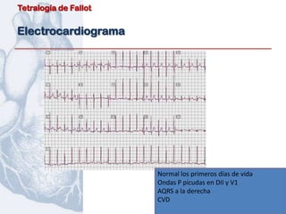 Tetralogía de Fallot


Electrocardiograma




                       Normal los primeros días de vida
                       Ondas P picudas en DII y V1
                       AQRS a la derecha
                       CVD
 