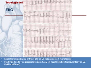 Tetralogía de Fallot


     EKG




•   Existe transición brusca entre el QRS en V1 (básicamente R monofásica)
•   Positividad onda T en precordiales derechas y sin negatividad de las izquierdas y en V2
    (QRS isodifásico)
 
