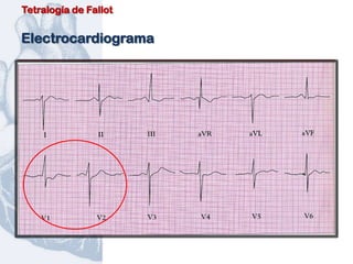 Tetralogía de Fallot


Electrocardiograma
 