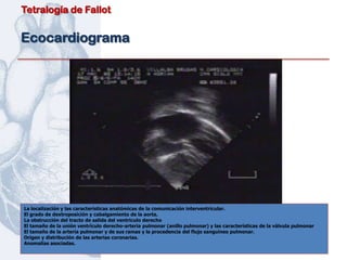 Tetralogía de Fallot


Ecocardiograma




La localización y las características anatómicas de la comunicación interventricular.
El grado de dextroposición y cabalgamiento de la aorta.
La obstrucción del tracto de salida del ventriculo derecho
El tamaño de la unión ventrículo derecho-arteria pulmonar (anillo pulmonar) y las características de la válvula pulmonar
El tamaño de la arteria pulmonar y de sus ramas y la procedencia del flujo sanguíneo pulmonar.
Origen y distribución de las arterias coronarias.
Anomalías asociadas.
 