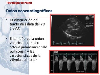 Tetralogía de Fallot


Datos ecocardiográficos

• La obstrucción del
  tracto de salida del VD
  (TSVD)

• El tamaño de la unión
  ventrículo derecho-
  arteria pulmonar (anillo
  pulmonar) y las
  características de la
  válvula pulmonar.
 