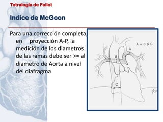 Tetralogía de Fallot


Indice de McGoon

Para una corrección completa,
  en proyección A-P, la
  medición de los diametros
  de las ramas debe ser >= al
  diametro de Aorta a nivel
  del diafragma
 