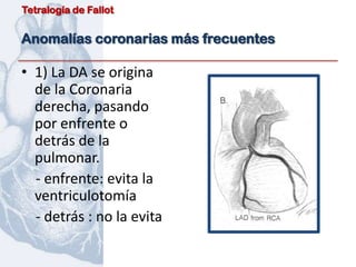 Tetralogía de Fallot


Anomalías coronarias más frecuentes

• 1) La DA se origina
  de la Coronaria
  derecha, pasando
  por enfrente o
  detrás de la
  pulmonar.
  - enfrente: evita la
  ventriculotomía
  - detrás : no la evita
 
