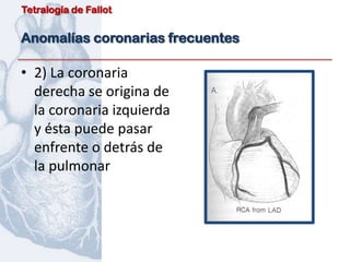 Tetralogía de Fallot


Anomalías coronarias frecuentes

• 2) La coronaria
  derecha se origina de
  la coronaria izquierda
  y ésta puede pasar
  enfrente o detrás de
  la pulmonar
 