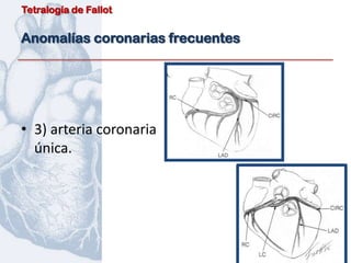 Tetralogía de Fallot


Anomalías coronarias frecuentes




• 3) arteria coronaria
  única.
 