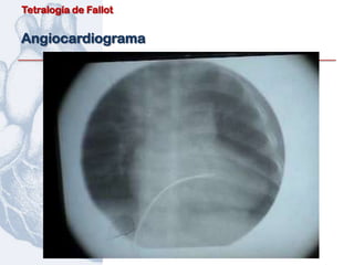 Tetralogía de Fallot


Angiocardiograma
 