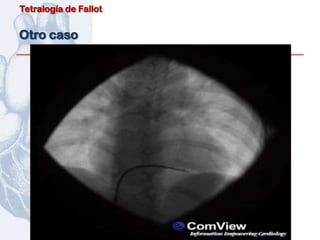 Tetralogía de Fallot


Otro caso
 