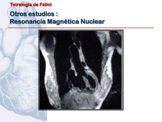 Tetralogía de Fallot

Otros estudios :
Resonancia Magnética Nuclear
 