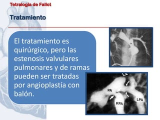 Tetralogía de Fallot


Tratamiento


  El tratamiento es
  quirúrgico, pero las
  estenosis valvulares
  pulmonares y de ramas
  pueden ser tratadas
  por angioplastía con
  balón.
 