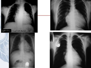Tetralogía de Fallot
 
