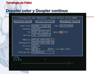 Tetralogía de Fallot


Doppler color y Doopler continuo
 