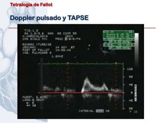 Tetralogía de Fallot


Doppler pulsado y TAPSE
 