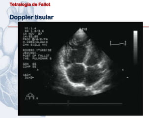 Tetralogía de Fallot


Doppler tisular
 