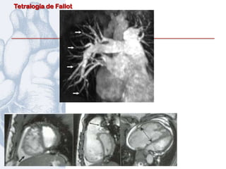 Tetralogía de Fallot
 