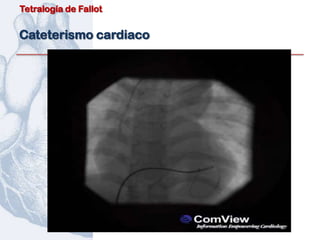 Tetralogía de Fallot


Cateterismo cardiaco
 
