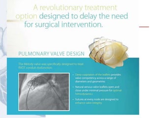 Tetralogía de Fallot
 
