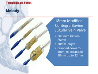 Tetralogía de Fallot


Melody

                       18mm Modified
                       Contegra Bovine
                       Jugular Vein Valve
                       • Platinum Iridium
                         Frame
                       • 28mm length
                       • Crimped down to
                         6mm, re-expanded
                         18mm up to 22mm
 
