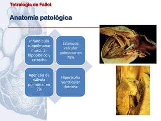 Tetralogía de Fallot


Anatomía patológica


         Infundíbulo
                         Estenosis
        subpulmonar
                          valvular
          muscular
                        pulmonar en
        hipoplásico y
                            75%
           estrecho


        Agenesia de
                        Hipertrofia
           válvula
                        ventricular
        pulmonar en
                         derecha
             2%
 