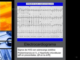 Electrocardiograma
Signos de HVD con sobrecarga sistólica
Predominancia en V3 x Hipertrofia infundibular
[qR en precordiales, qR en la aVR]
                                                 13
 