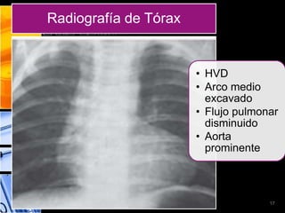Radiografía de Tórax


                       • HVD
                       • Arco medio
                         excavado
                       • Flujo pulmonar
                         disminuido
                       • Aorta
                         prominente



                                     17
 