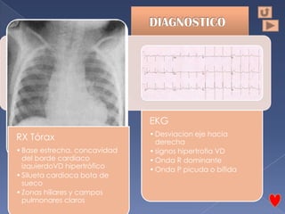 EKG
                              • Desviacion eje hacia
RX Tórax                        derecha
• Base estrecha, concavidad   • signos hipertrofia VD
  del borde cardiaco          • Onda R dominante
  izquierdoVD hipertrófico    • Onda P picuda o bífida
• Silueta cardiaca bota de
  sueco
• Zonas hiliares y campos
  pulmonares claros
 