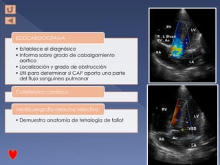 ECOCARDIOGRAMA

• Establece el diagnósico
• Informa sobre grado de cabalgamiento
  aortico
• Localización y grado de obstrucción
• Util para determinar si CAP aporta una parte
  del flujo sanguineo pulmonar

Cateterismo cardiaco


Ventriculografía derecha selectiva

• Demuestra anatomía de tetralogía de fallot
 