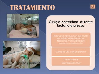 Cirugía correctora durante
     lactancia precoz


  Eliminar la obstrucción del tracto
      de salida VD retirando los
      fascículos musculares que
        producen obstrucción


    Cerrar la CIV con un parche


            Valvulotomía
          Válvula pulmonar
 