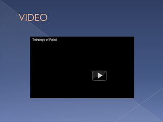 TETRALOGIA DE FALLOT