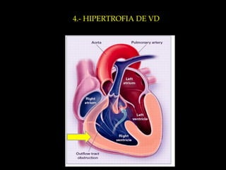 4.- HIPERTROFIA DE VD 