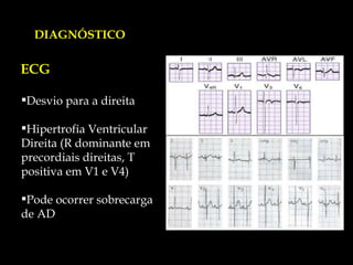ECG Desvio para a direita Hipertrofia Ventricular Direita (R dominante em precordiais direitas, T positiva em V1 e V4) Pode ocorrer sobrecarga de AD DIAGNÓSTICO 